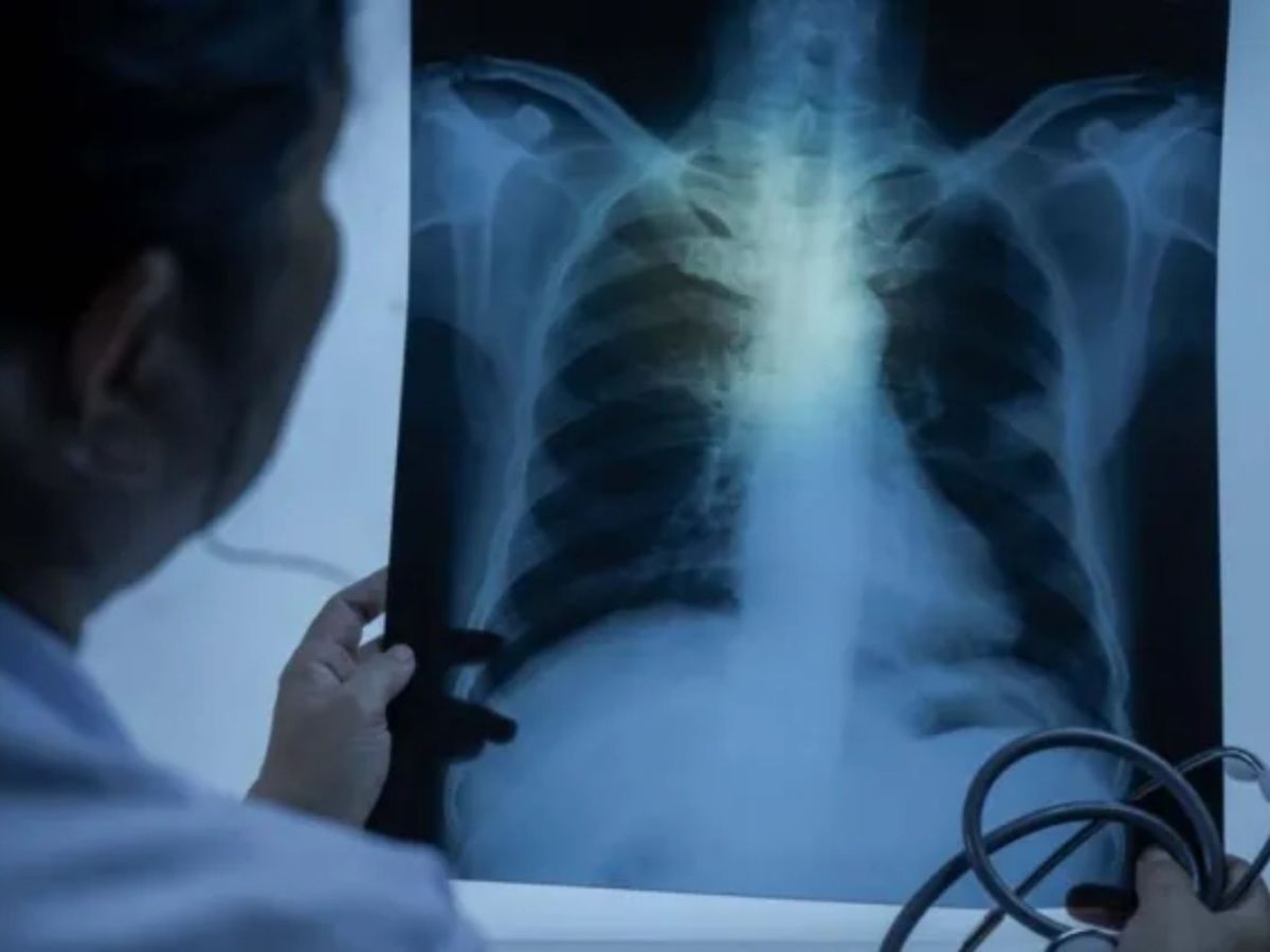 Incremento de los casos de silicosis en 2025, año que se cerró con un aumento de los partes de enfermedad&nbsp;profesional